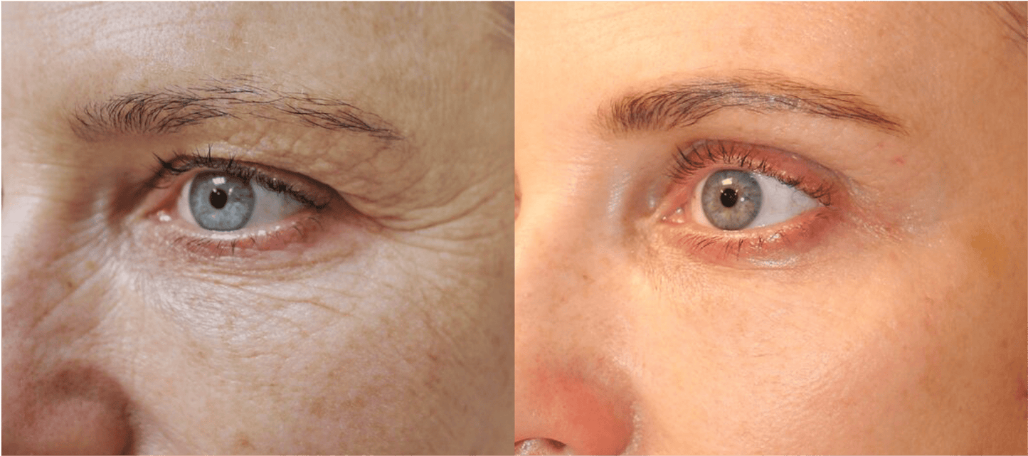 CollagenLift™ SkinGlow Paris